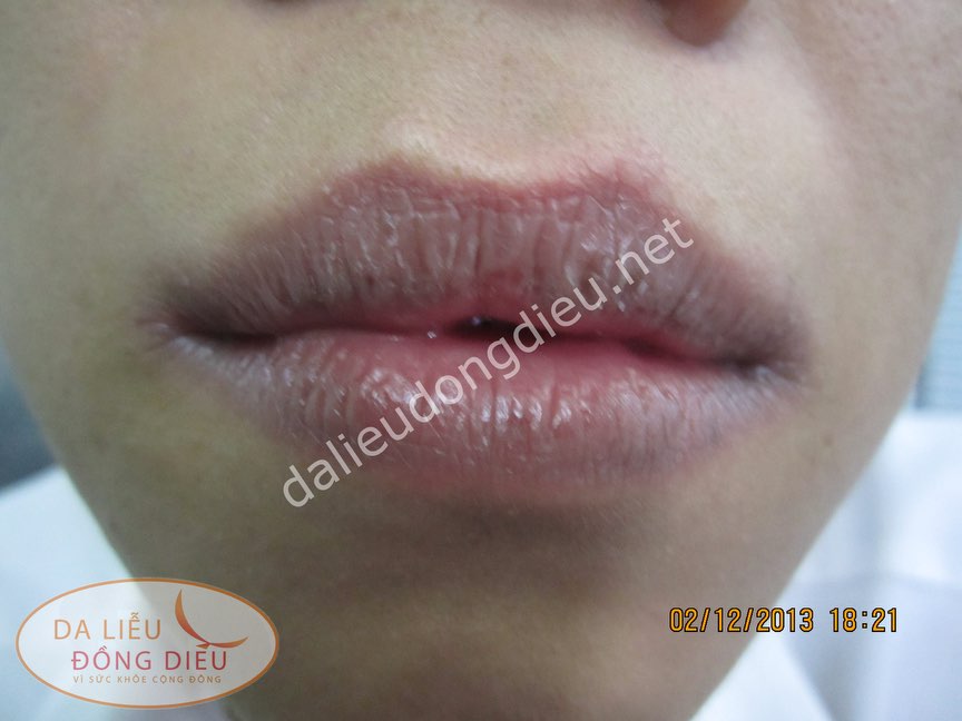 VIÊM MÔI DO NẤM CANDIDA 6 