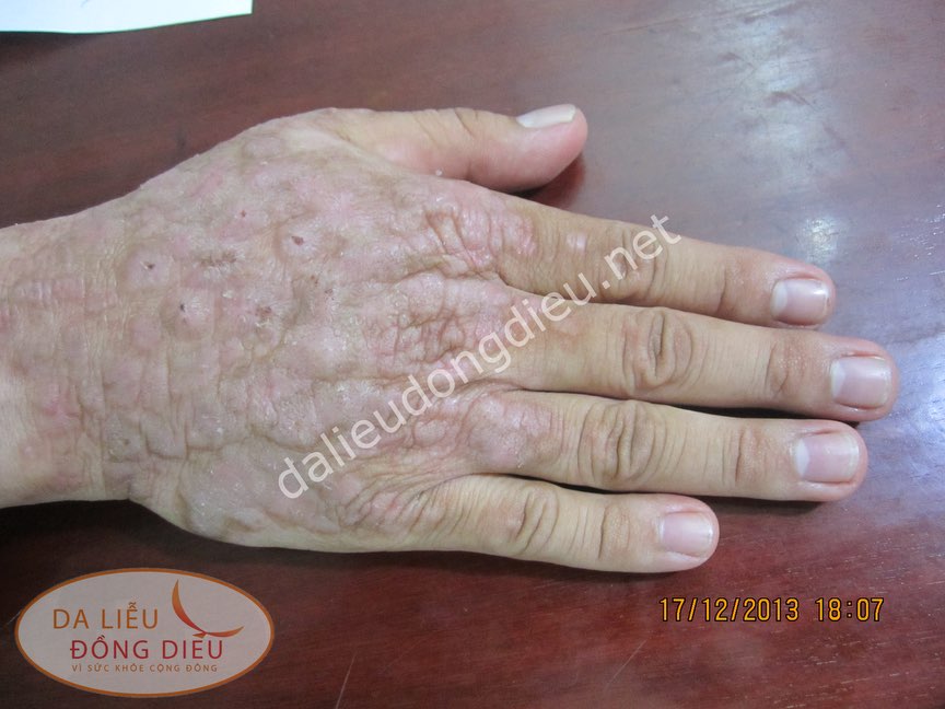Nấm sâu chàm hóa