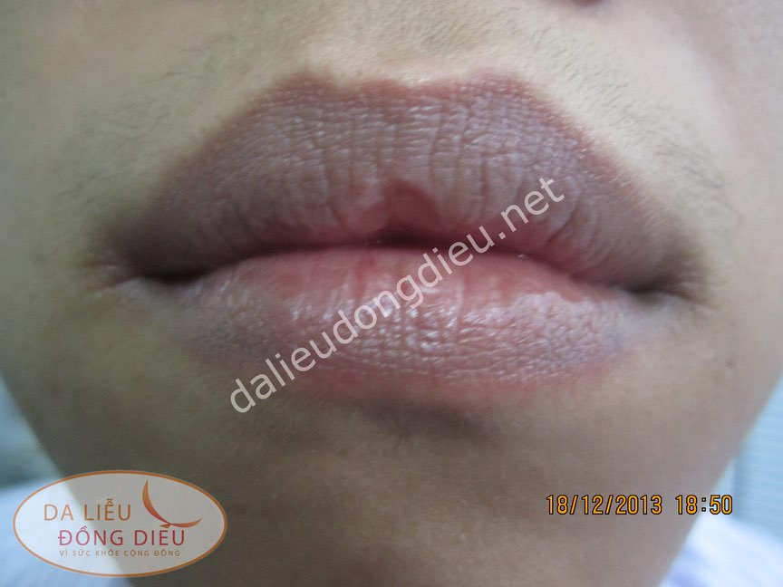 Viêm môi do nấm Candida