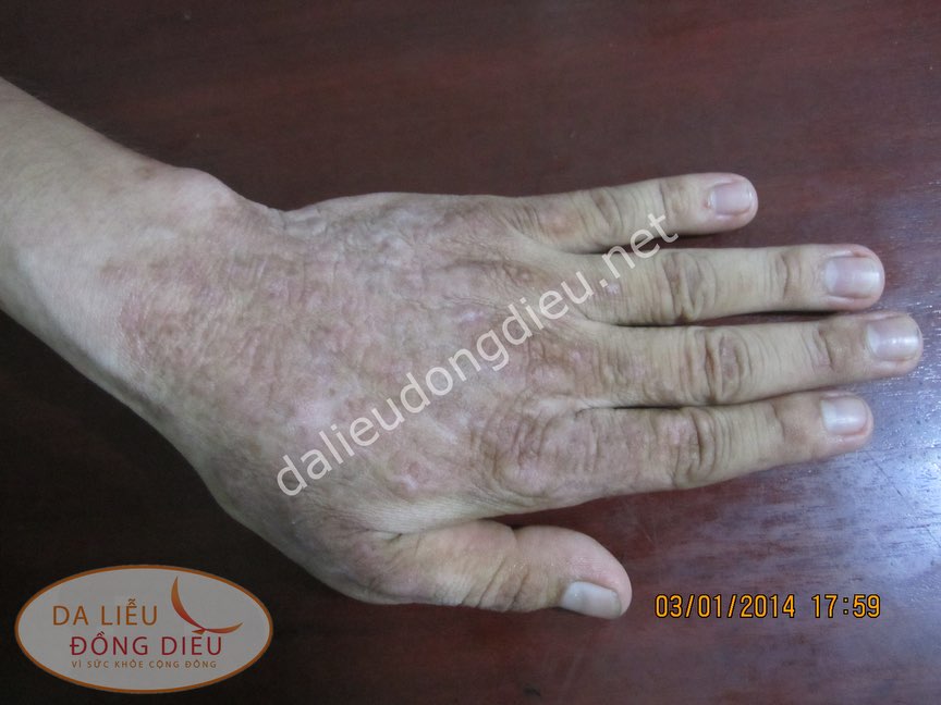 Nấm sâu chàm hóa