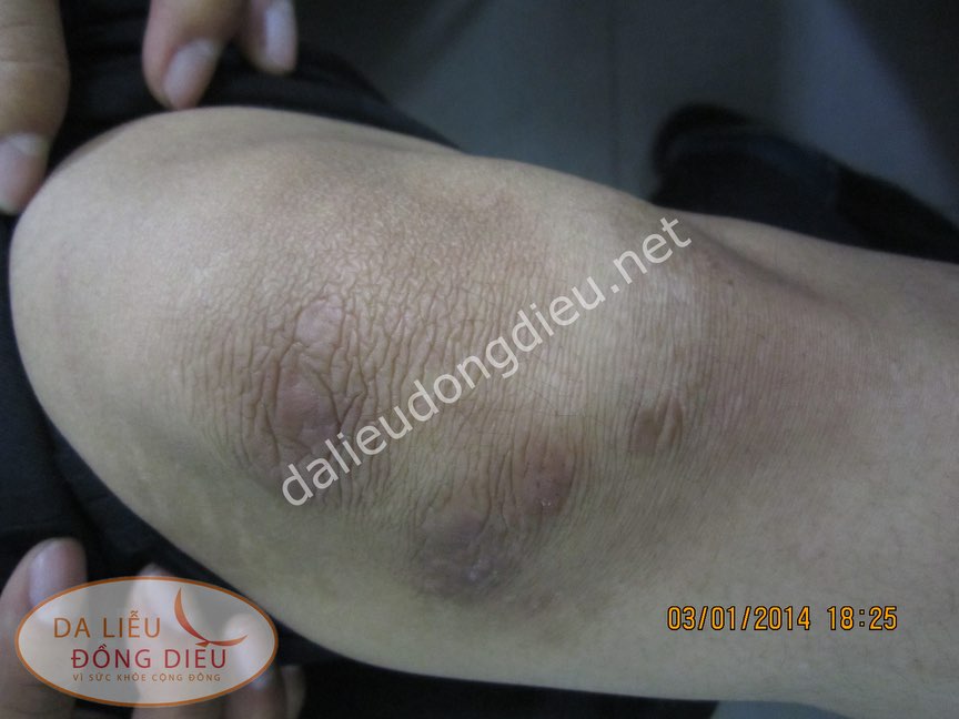Nấm sâu đầu gối