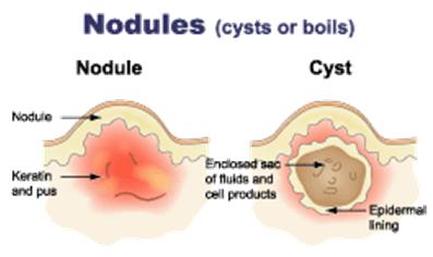 Nodules